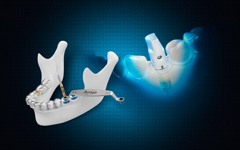 Cirurgia guiada Arcsys — guia impresso e implante virtual